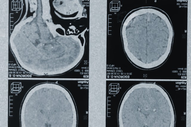 What Happens To Your Body Without Long-Term Sleep